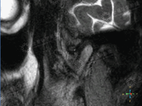 盘位置的变化右侧颞颌关节盘颌关系可复性前移位通过磁共振高分辨扫描