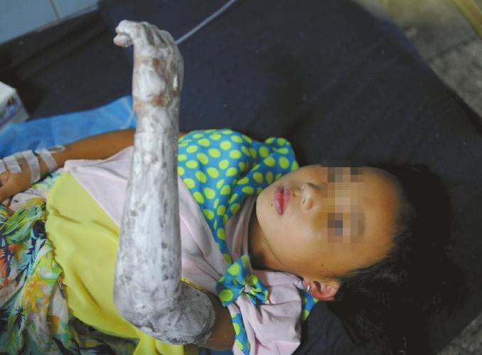 妈妈被困火海 6岁女儿抱她双腿往外拖被烧伤_新闻频道