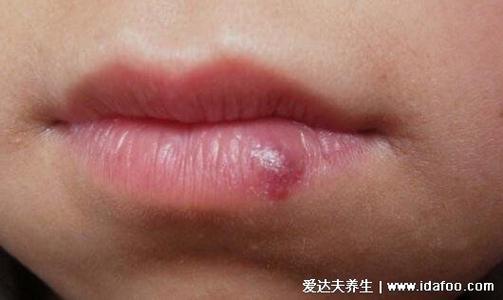 成人唇部血管瘤初期图片及症状,紫红色的柔软瘤子会增大出血