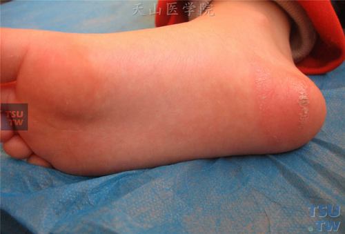 足趾跖面,跖部,足跟皮肤发红,干燥,光亮,足跟部可见皮肤纹理加深,线状