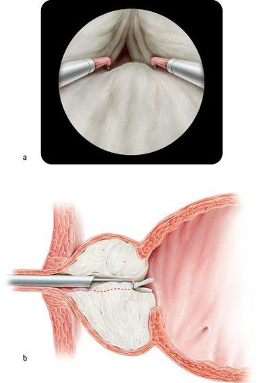 前列腺切除(保留尿道)机器人辅助腹腔镜前列腺切除(保留尿道)经膀胱