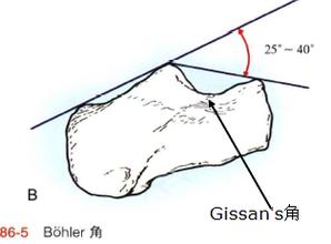 1)bohler25~40°    ;跟骨的解剖学标志最重要的就是两个角度:解