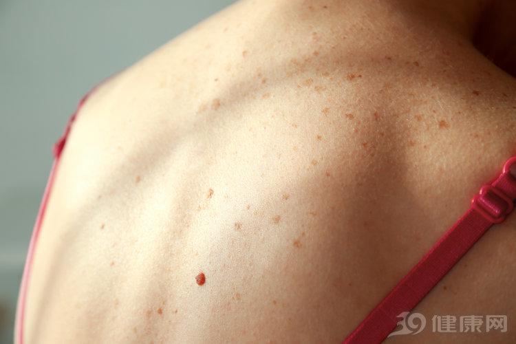 女子身上长红点确诊肝癌医生提醒皮肤这1变化或是肝癌前兆