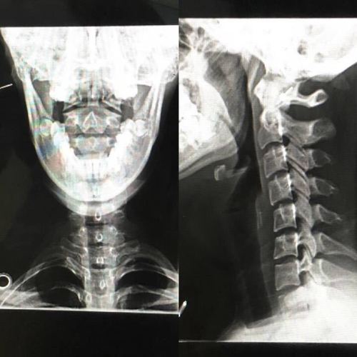 下面上两张典型的寰枢关节半脱位的影像学检查