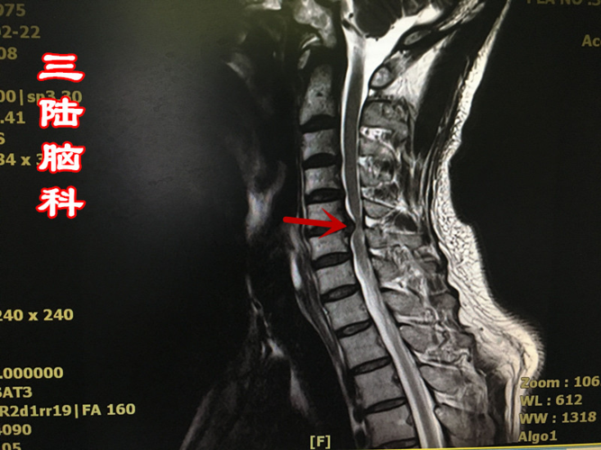 三陆脑科谈脑病︱颈椎间盘突出患者的救助案例