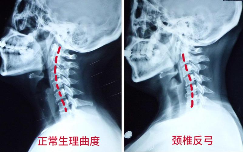 "颈椎曲度变直";再严重一点,颈椎向相反方向弯曲,就形成了"颈椎反弓"