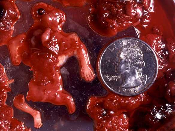 3) 早期堕胎:9周大的胎儿 向左转  向右转