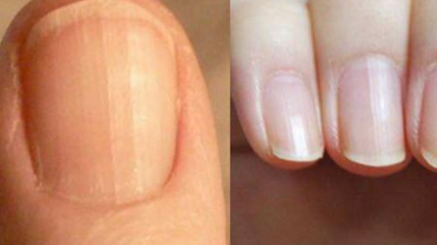 提醒:指甲若长成4种样子,可能是癌或疾病的信号,还请留心观察
