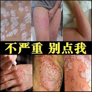 99皮炎平湿疹皮肤瘙痒成人炉甘石洗剂湿疹止痒去根外用专阴囊慢.