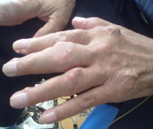 刘先生在我院检查时手指关节肿胀,结石