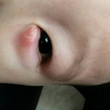 九个月宝宝眼角长了麦粒肿,会不会引起发烧,如何治疗?