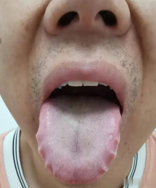 uc头条:舌红阴虚有热,舌白血虚有寒,舌胖气虚有湿,中医教你从舌象看病