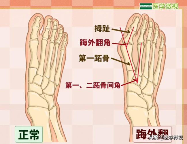大脚骨治疗(畸形的大脚骨,有这两种治疗方法)