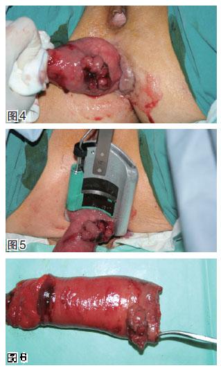 腹腔镜低位/超低位直肠前切除术 经肛门直肠脱出外翻
