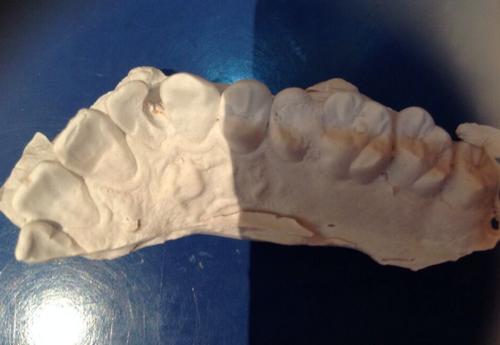 上颌前牙牙体邻面树脂美容仿生再修复