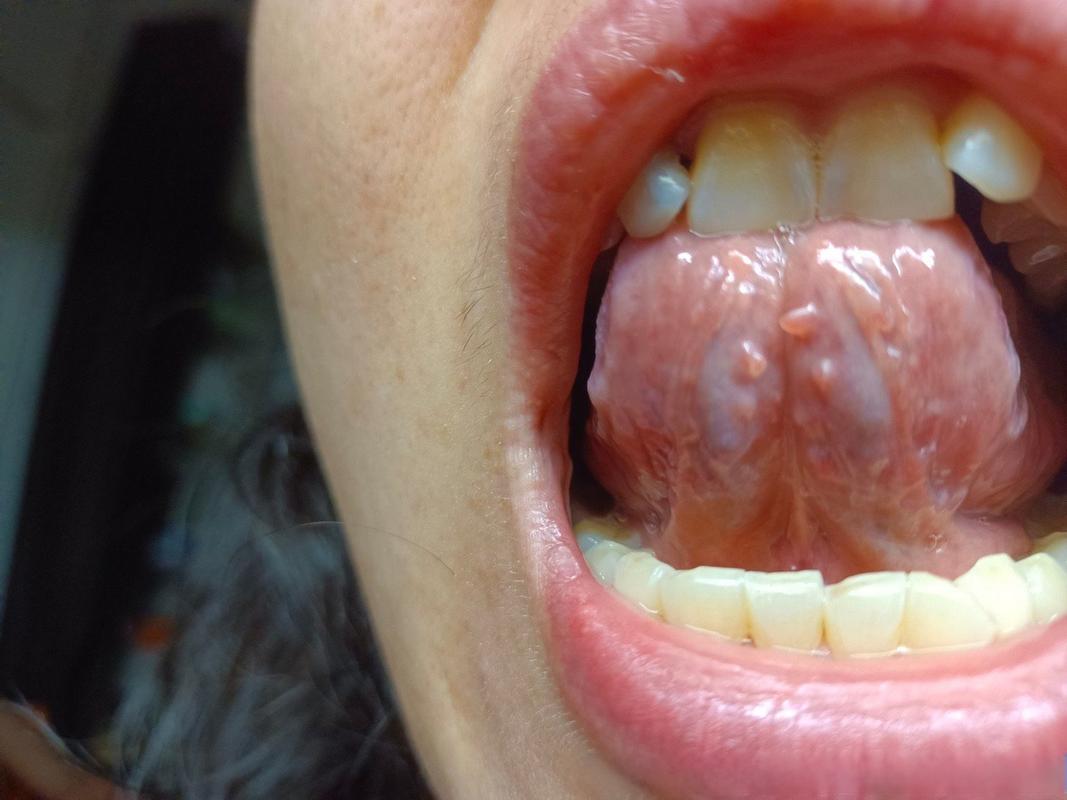 口腔尖锐湿疣表面会不会出现有明显的毛细血管扩张血