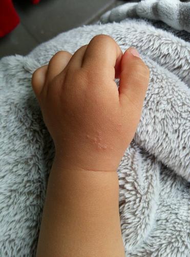 问:孩子一岁三个月,前两天发现手背有些密集米粒状皮疹,今天好像又多