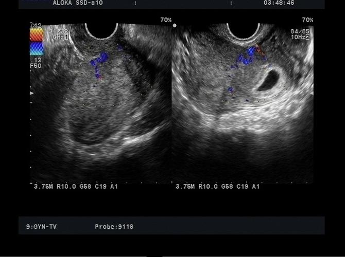 双角子宫之左侧宫腔内早孕 - 超声医学讨论版 - 爱爱医医学论坛