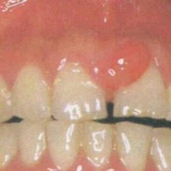 关于牙齿的健康每个人都应该知道的常识" 牙龈息肉是患牙邻牙合面出现