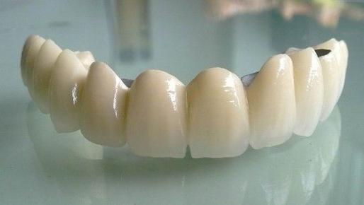 普通烤瓷牙就是镍铬合金材料制成,属于最低端的烤瓷牙,价格大概在300