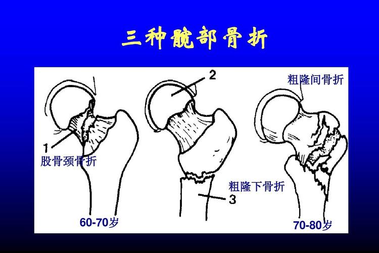 三种髋部骨折 粗隆间骨折 股骨颈骨折 粗隆下骨折 60-70岁 70-80岁