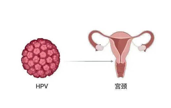 健康科普 | hpv 感染了,就一定会得宫颈癌吗?_伴侣_女性_子宫