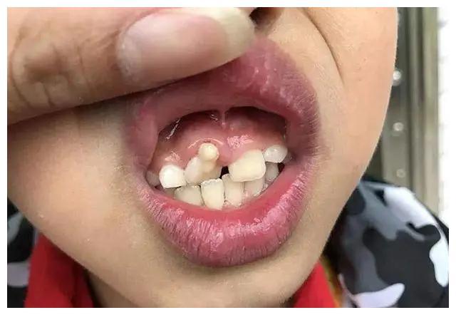 孩子长出"双排牙",却是父母惯娃惹的祸,家长都要警醒|乳牙|双排|牙齿