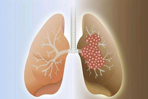 小细胞肺癌临床表现,治疗原则是什么