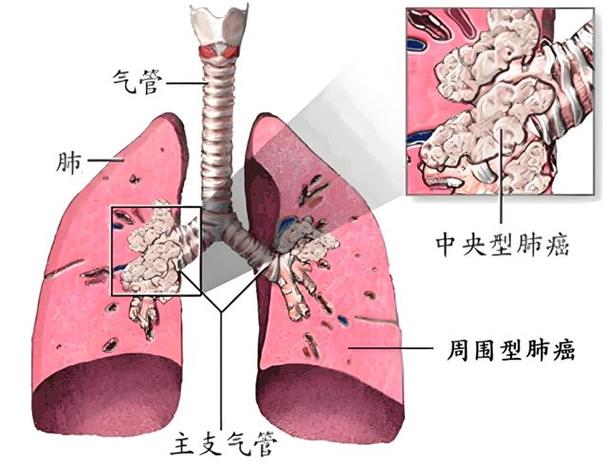 被分为中央型和周围型,前者主要发生在肺门附近的支气管或叶支气管中