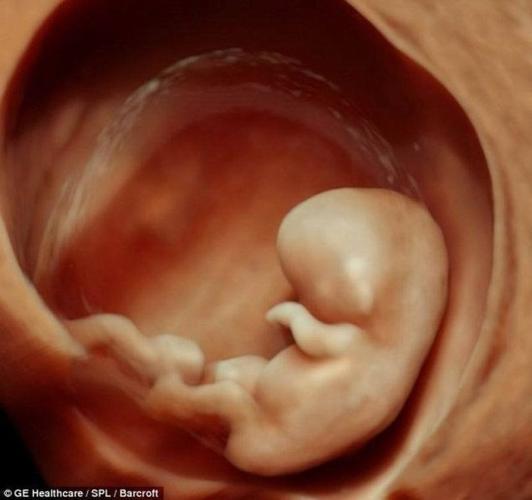 胎儿怀孕6个周的胎儿3d超声波扫描图像这项技术可帮助医生及早探测到