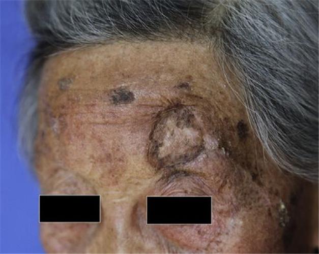 脸良性黑色素瘤早期图片
