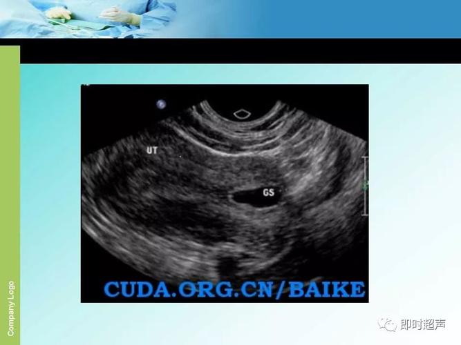 超声如何诊断瘢痕子宫妊娠?及疤痕子宫妊娠分娩,讲解的太细致了!