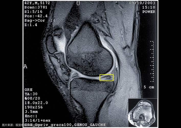 膝关节半月板损伤怎么办