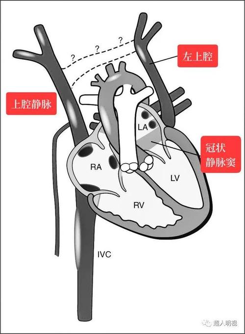 胎儿持续性左上腔静脉lsvc