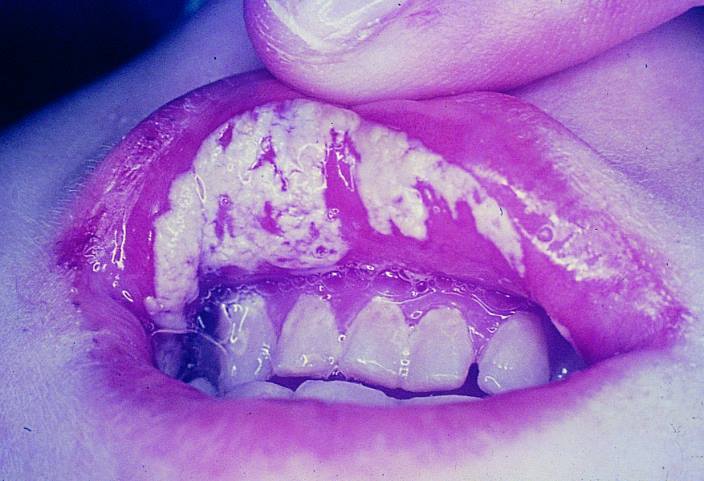 口腔念珠菌病唇黏膜