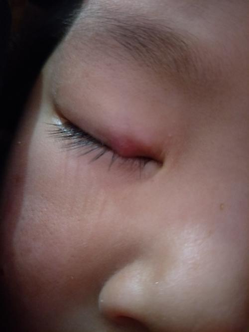 两岁小孩做了霰粒肿手术眼皮刀口处一直红红的又长了一拖越来越大是没