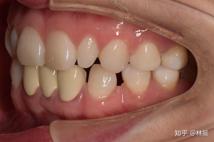 欢悦口腔真实案例分享牙齿瓷贴面全文病人角度