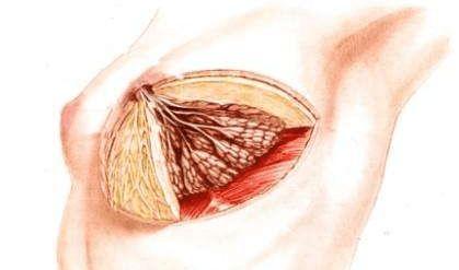 慢性乳腺炎该如何治疗?