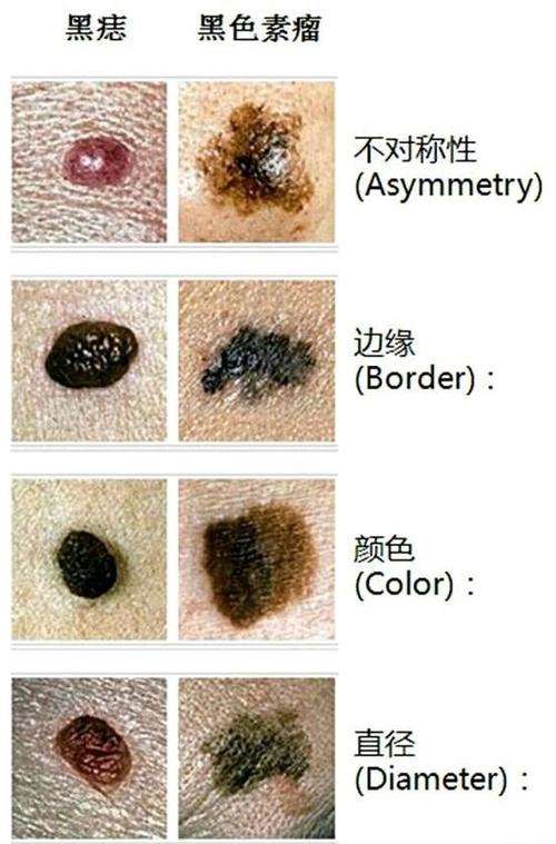 痣(nevue)在医学上称作痣细胞或黑素细胞痣,是表皮,真皮内黑素细胞