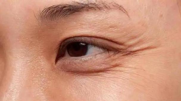 眼周皱纹的出现严重影响人的整体面貌,有许多方法可以改善
