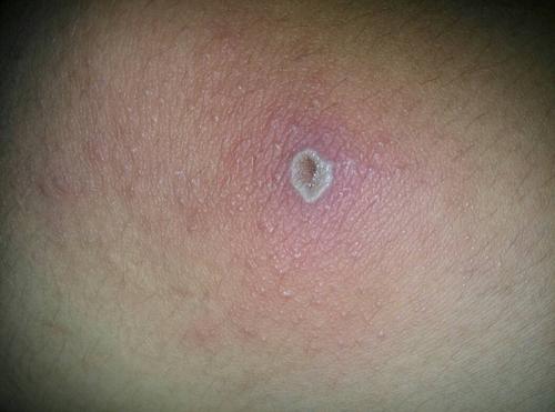我是男生今年十九岁,最近膝盖擦破了皮慢慢 出现了很多水痘似的痘痘