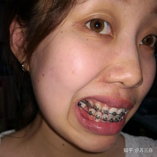 骨性嘴凸,牙齿矫正,上海口腔病防治院 - 知乎
