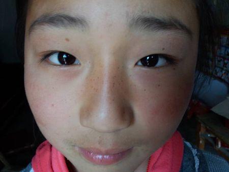 9岁半小女孩鼻梁上那么多黑点是什么呀?