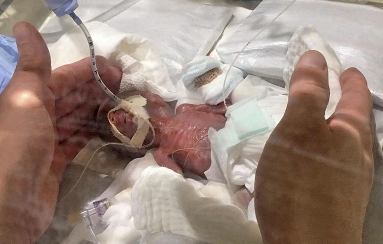 "世界最小的男婴"平安出院 出生时仅268克