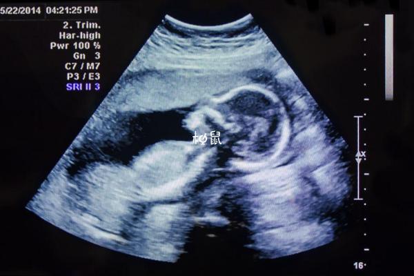 医生也不允许告知家属胎儿性别,一般生儿子的四维彩超图片