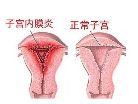 1,导致女性性冷淡子宫内膜炎会使阴道分泌物增多,同时伴有腰酸,腰痛等