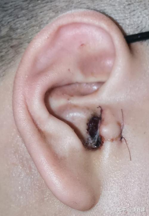 右耳朵鼓膜穿孔15年终于决定手术修补耳膜了