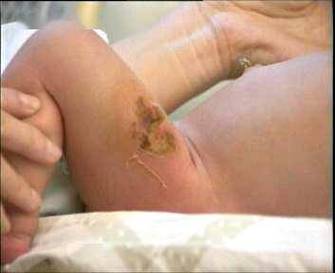 刚出生的宝宝脐部发红伴有分泌物警惕新生儿败血症