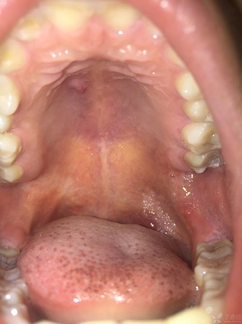 上颚长个红色的疙瘩,请指导下这个是什么疾病呢??(急) - 口腔 -丁香园