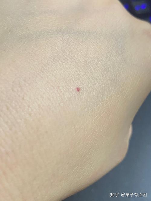 皮肤出现不少出血点小的如针尖大小呈扁平状大的如小米般大小呈凸起状